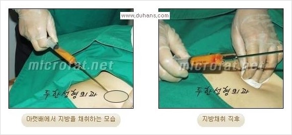 [두한성형외과 경쟁력 미세지방이식] - [관자놀이(측두부) 지방이식] 관련 이미지 2