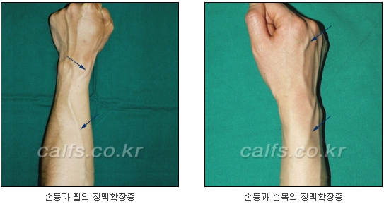 두한성형외과 보기싫은 혈관제거 - 눈밑혈관, 손과 팔의 혈관확장증 치료 관련 이미지 22