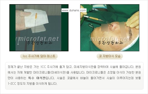 [두한성형외과의 No.1 경쟁력 미세(자가)지방이식] - [코높힘 미세(자가)지방이식 ①] 관련 이미지 8