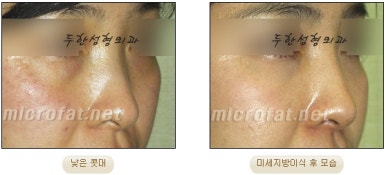 [Duhan Plastic Surgery Facial Fat Grafting] - [Fat Grafting Rhinoplasty] image 17