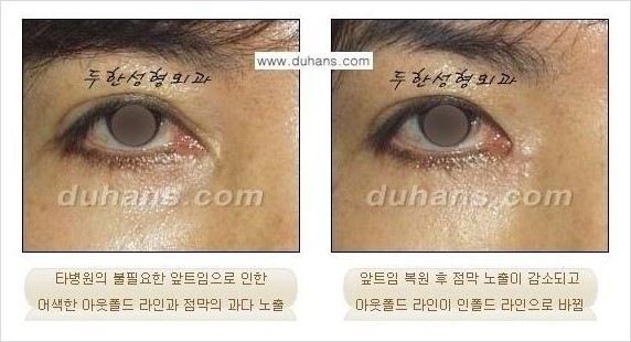 [두한성형외과 경쟁력 쌍꺼풀 재수술, 극한 눈재수술] - [쌍꺼풀 재수술, 눈재수술 실패의 원인 안내] 관련 이미지 2