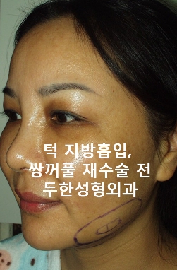 얼굴지방이식 두한성형외과 - 볼지방이식 관련 이미지 50