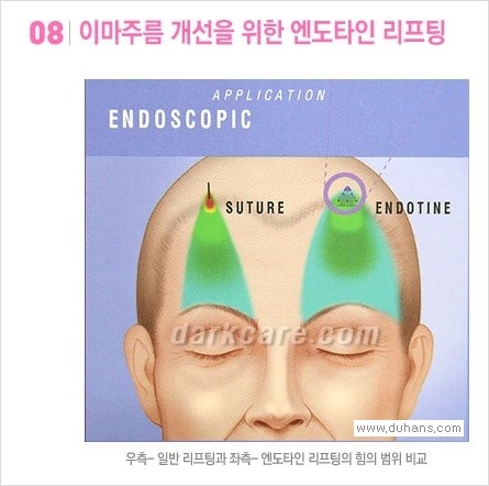 [두한성형외과 경쟁력 다크써클 치료] - [다크써클 + 엔도타인 리프팅 콤비 프로그램] 관련 이미지 9