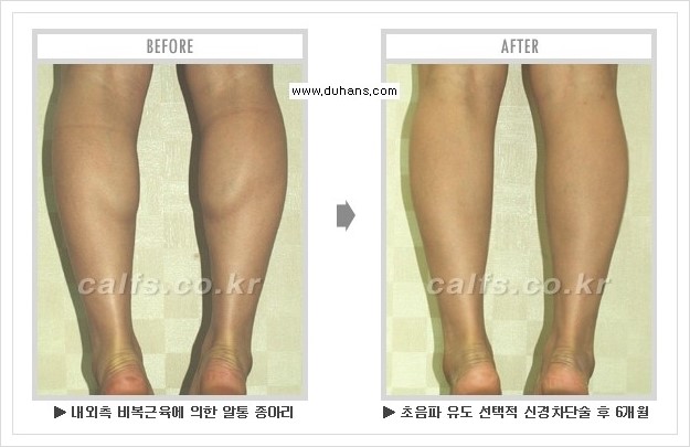 [두한성형외과 경쟁력 멀티종아리성형] - [종아리성형 방법별 전후 주의사항] 관련 이미지 19