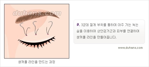​[두한성형외과 경쟁력 눈성형] - [자연스럽고 아름다운 쌍꺼풀의 기준] 관련 이미지 15