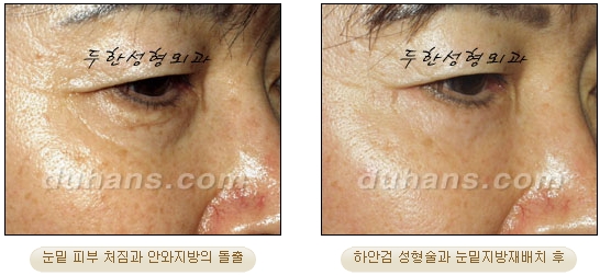 [Duhan Plastic Surgery Ophthalmic Plastic Surgery] - [Lower Blepharoplasty] image 32