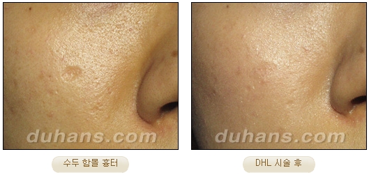 [DuHan Plastic Surgery Scar] - [DHL Simple Scar Treatment] image 10
