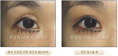 Duhan Plastic Surgery Ophthalmic Reoperation - What Is a Successful Double Eyelid Revision Surgery? image 15
