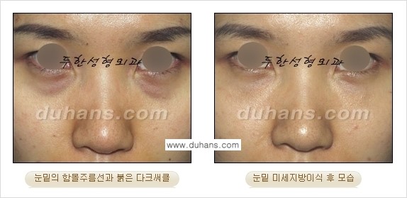[두한성형외과 상큼하고 환한 눈매완성] - [눈밑 미세지방이식 ①] 관련 이미지 3