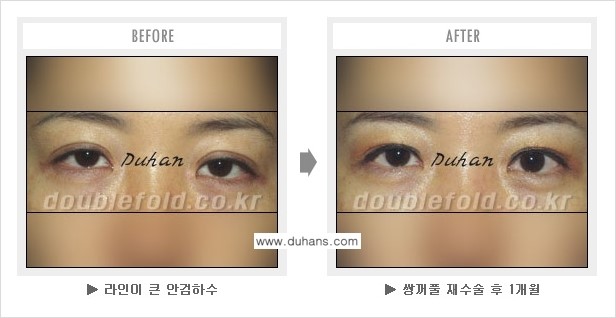 ​[두한성형외과 쌍꺼풀 재수술] - [푸는 수술을 하고 내원했을 경우의 문제] 관련 이미지 2
