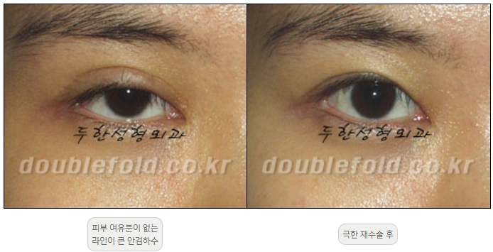 [Duhan Plastic Surgery Double Eyelid Revision] - [Thick Double Eyelid Line] image 51