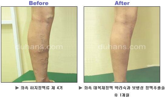 [두한성형외과 정맥류] - [하지정맥류, 정맥확장증, 혈관확장증] 관련 이미지 30