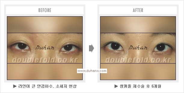 [두한성형외과 경쟁력 쌍꺼풀 재수술, 극한 눈재수술] - [두툼한 소세지 쌍꺼풀 라인 교정] 관련 이미지 14