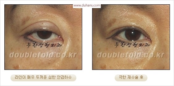 [두한성형외과 경쟁력 눈성형] - [극한 재수술, 함몰된 눈꺼풀 라인교정, 안검하수(졸리운 눈매)] 관련 이미지 25