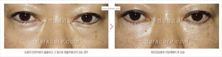 [두한성형외과 경쟁력 눈밑성형] - [눈밑 다크써클 맞춤 치료 방법] 관련 이미지 11