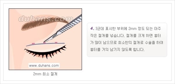 [두한성형외과 경쟁력 눈성형, 쌍꺼풀 수술] - [퀵쌍꺼풀(부분절개법)의 수술 안내] 관련 이미지 5