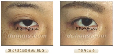 [Special Double Eyelid Revision Surgery at Duhan Plastic Surgery] - [Restorative Surgery for Damaged Double Eyelid Eye Shape] image 20