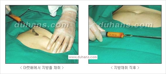 [두한성형외과 경쟁력 눈밑성형] - [밝고 젊게 보이는 눈밑 애교살 미세지방이식] 관련 이미지 1