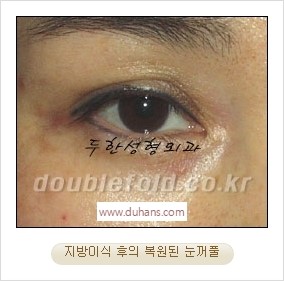 [두한성형외과 경쟁력 쌍꺼풀 재수술 리더] - [풀린 쌍꺼풀, 풀려버린 쌍꺼풀 재수술 방법 안내] 관련 이미지 12