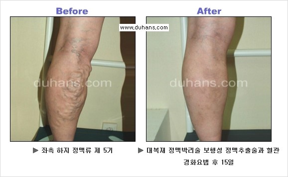 [두한성형외과 경쟁력 멀티종아리성형] - [정맥류 - 혈관확장증 질문과 답변 안내] 관련 이미지 6