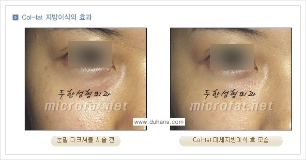 [두한성형외과 경쟁력 미세지방이식] - [상표등록 "Col-fat(콜펫) 지방이식"의 장점 안내] 관련 이미지 4