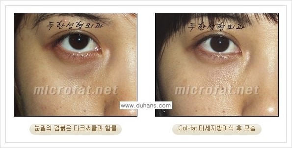 [두한성형외과 경쟁력 눈밑성형] - [눈밑 다크써클과 눈밑 함몰주름의 최적화 교정방법 안내] 관련 이미지 26
