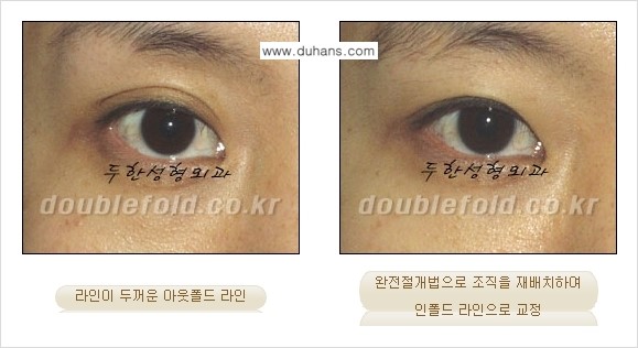 [두한성형외과] - [아웃폴드를 인폴드로 변화시키는 쌍꺼풀재수술] 관련 이미지 7