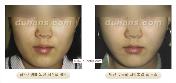 [두한성형외과 경쟁력 지방흡입] - [얼굴, 볼살, 턱살, 턱선의 초음파 지방흡입] 관련 이미지 24