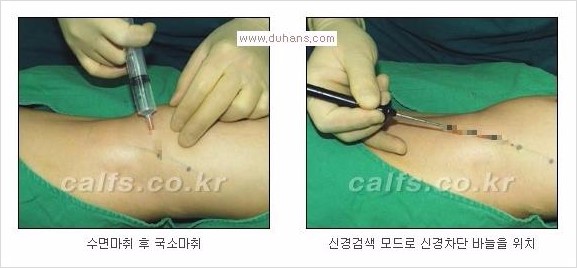 [두한성형외과 Dr. 컬럼 - 타 병원의 종아리 퇴축술 이후 문제가 발생한 경우] 관련 이미지 6