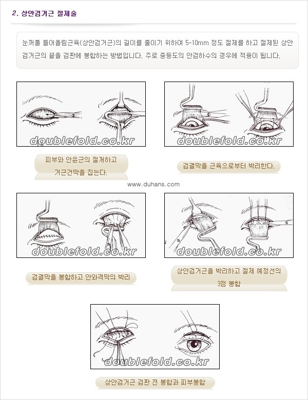 [두한성형외과 NO.1 "극한 눈(쌍꺼풀 재수술)"] - [안검하수(졸린눈매) 재수술 안내 2.] 관련 이미지 7