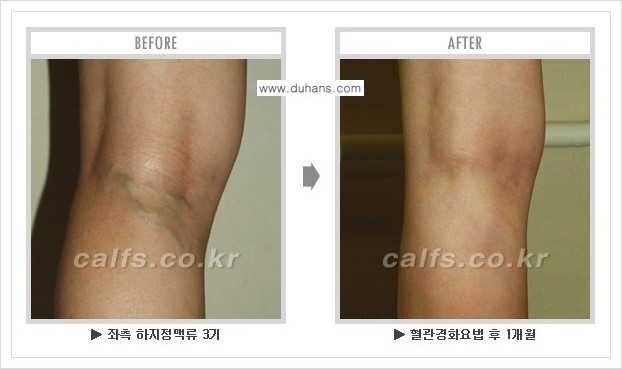 [두한성형외과 경쟁력 정맥류 치료] - [하지정맥류 사진 자료 안내 1.] 관련 이미지 6