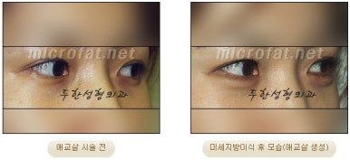 두한성형외과 눈밑성형 - 애교필러 후 눈밑재수술 관련 이미지 15