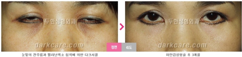 [두한성형외과 다크서클] - [다크서클 전후사진 검증] 관련 이미지 124