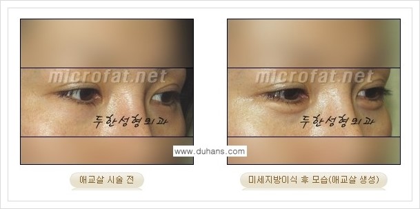 [두한성형외과 경쟁력 눈밑성형] - [애교살과 다크써클과의 관계] 관련 이미지 11