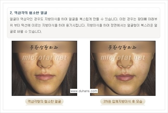 ⁠⁠[두한성형외과 경쟁력 볼살지방이식] - [심하게 야윈 주름이 있는 얼굴, 역삼각형 협소한 얼굴, 광대뼈가 돌출되어 보이는 경우 안내] 관련 이미지 12