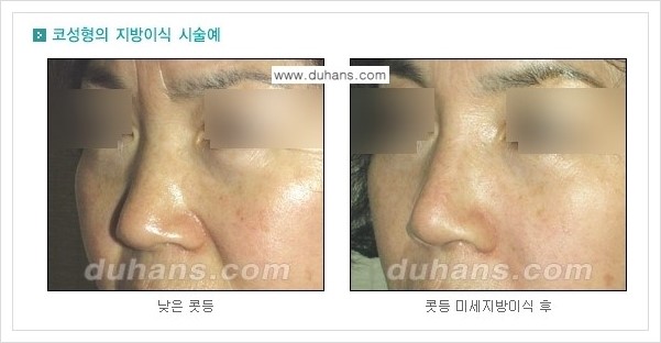 [두한성형외과 경쟁력 코성형] - [자연스러운 코 미세지방이식] 관련 이미지 1