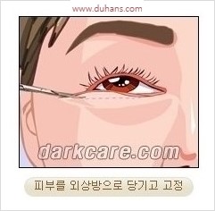 [두한성형외과 경쟁력 안검성형] - [젊어 보이면서 개선된 인상을 주기 위한 성형] 관련 이미지 6