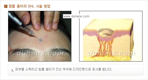 [두한성형외과 함몰 흉터 교정] - [동시에 3가지 시술로 효과적인 흉터의 교정 안내 ①] 관련 이미지 5