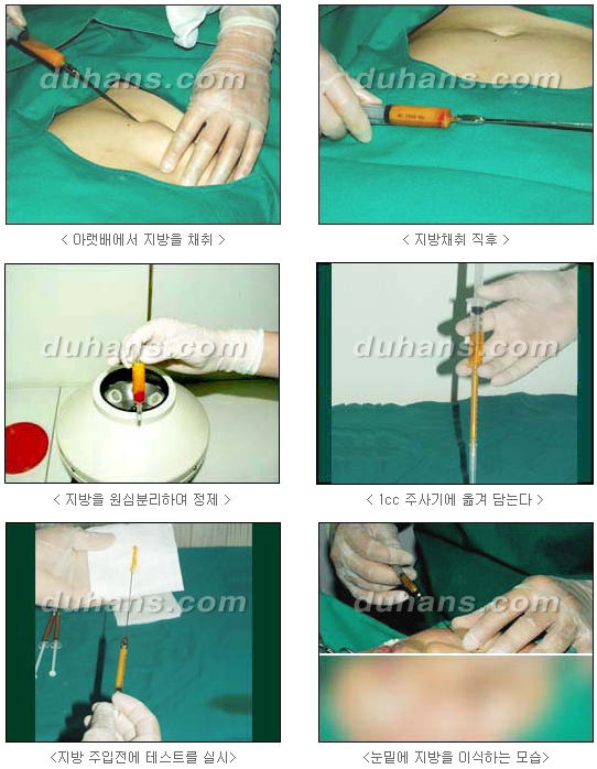 두한성형외과 눈밑성형 - 눈밑지방제거, 눈밑주름, 눈밑지방재배치 관련 이미지 58