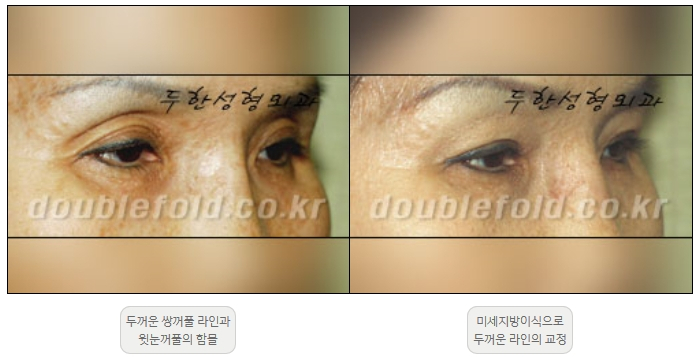[Duhan Plastic Surgery Double Eyelid Revision] - [Thick Double Eyelid Line] image 25
