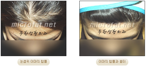 이마성형 두한성형외과 - 이마주름, 이마지방이식 관련 이미지 4