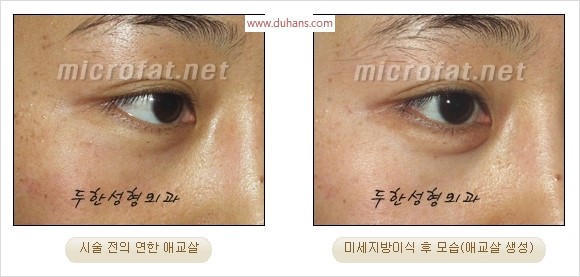 ​﻿[두한성형외과 경쟁력 지방이식] - [눈밑 애교살 시술을 위한 미세지방이식] 관련 이미지 16