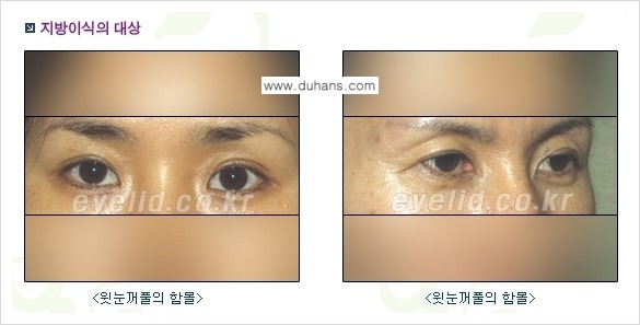 [두한성형외과 경쟁력 미세지방이식] - [꺼진(함몰된) 윗눈꺼풀 미세지방이식] 관련 이미지 1