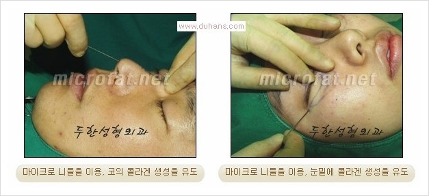 [두한성형외과 경쟁력 눈밑성형] - [눈밑 다크써클 치료에 대한 자주하는 질문과 답변 안내] 관련 이미지 3