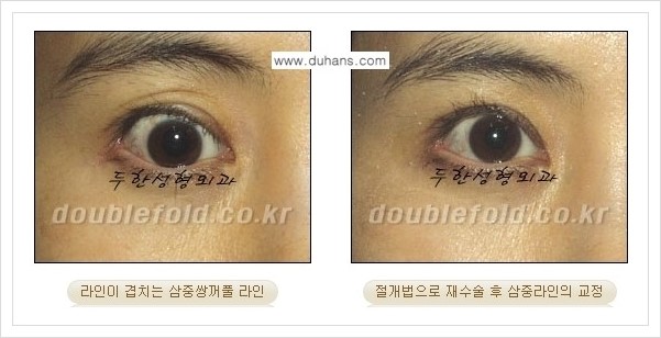 [두한성형외과 경쟁력 쌍꺼풀 재수술, 극한 재수술] - [삼중(세겹) 쌍꺼풀 라인의 교정 안내] 관련 이미지 2