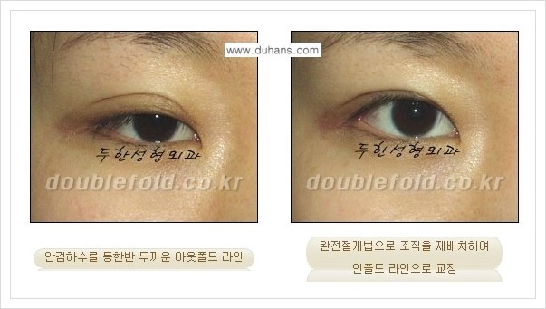 [두한성형외과 경쟁력 쌍꺼풀 재수술, 극한 눈재수술] - [심한 아웃폴드 쌍꺼풀 라인 재수술 방법] 관련 이미지 10