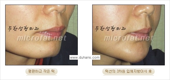 [두한성형외과의 경쟁력 미세지방이식] - [무턱교정 - 턱 미세지방이식 안내 2.] 관련 이미지 10