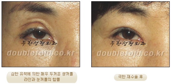 [DoubleFold Plastic Surgery Eye Surgery] - [Revision Surgery for Thick Double Eyelids] image 30