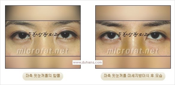 [두한성형외과 경쟁력 눈밑성형] - [다크써클 + 눈위 지방이식 콤비 프로그램] 관련 이미지 27