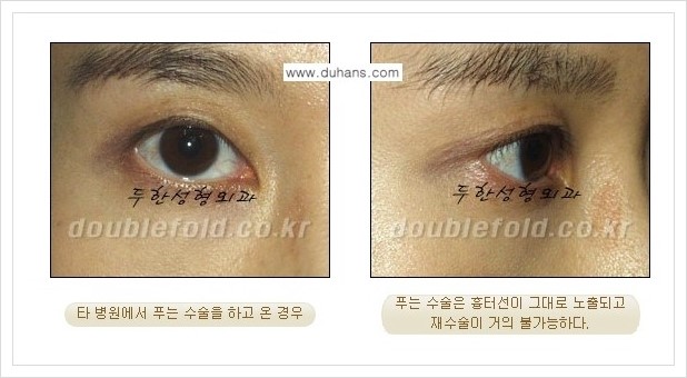 [두한성형외과] - [쌍꺼풀 재수술 푸는 수술을 하고 내원했을 경우의 문제] 관련 이미지 2